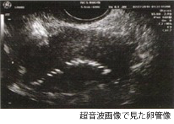 超音波下子宮卵管造影検査