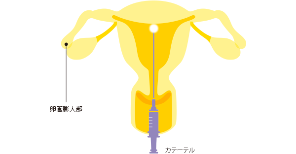 子宮口精子注射画像 